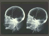 頭部動脈の立体血管造影写真